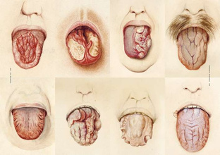 The Sick Rose Or; Disease and the Art 