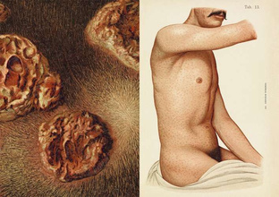 The Sick Rose Or; Disease and the Art 