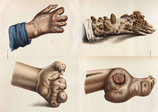 The Sick Rose Or; Disease and the Art 